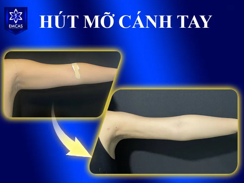 Tại EMCAS, công nghệ hút mỡ được tiếp cận theo hướng cá nhân hóa thay vì áp dụng một phương pháp cố định