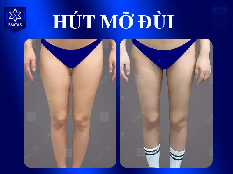 Tại EMCAS, dịch vụ hút mỡ được xây dựng theo hướng cá nhân hóa
