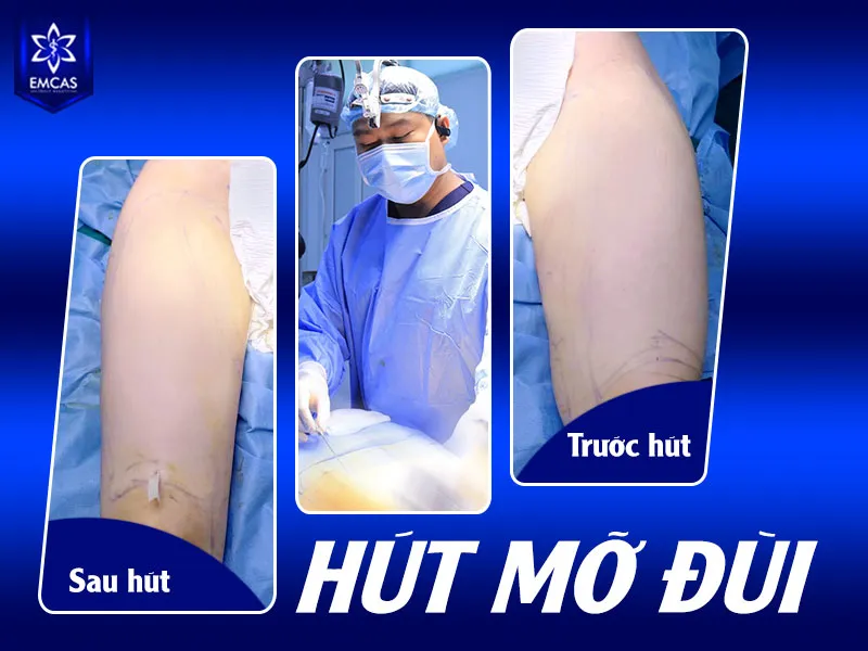 Tại EMCAS, quyết định hút mỡ luôn bắt đầu từ thăm khám, đánh giá thể trạng và xây dựng phác đồ cá nhân hóa
