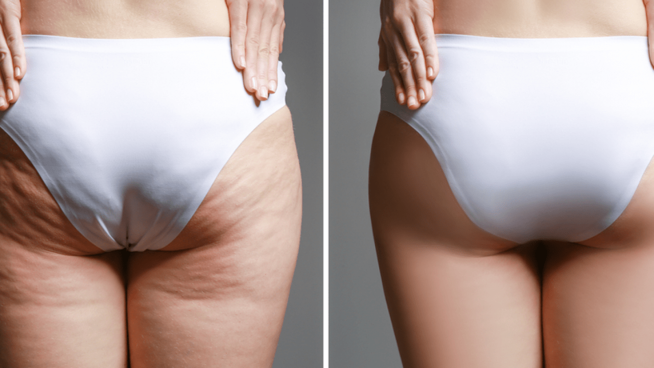 Sagging butt lifts
