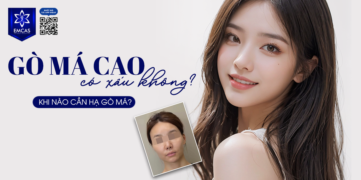 Gò Má Cao Có Xấu Không? Khi Nào Cần Hạ Gò Má?