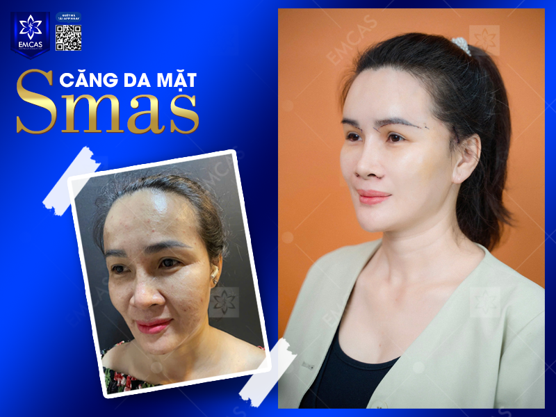 Căng Da Mặt SMAS - Giải Pháp Trẻ Hóa Làn Da