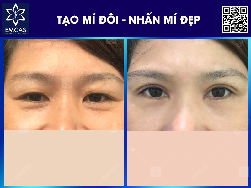 Cắt Mí Có Vĩnh Viễn Không