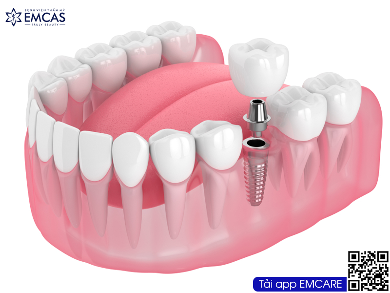 CẤY GHÉP IMPLANT