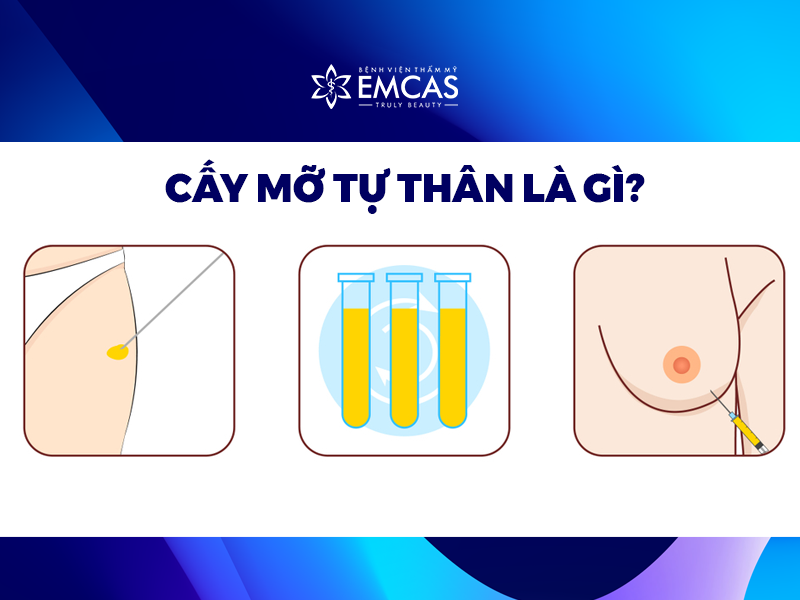 Cấy Mỡ Tự Thân Giá Bao Nhiêu