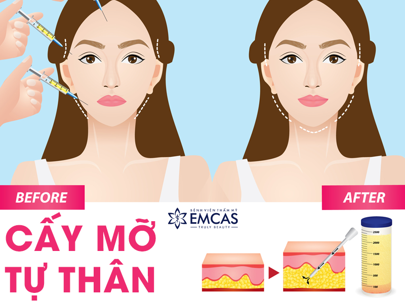 Nên Cấy Mỡ Tự Thân Hay Tiêm Filler