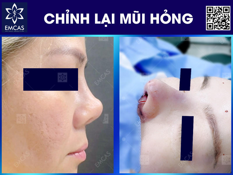 NÂNG MŨI HỎNG - BIỆN PHÁP KHẮC PHỤC