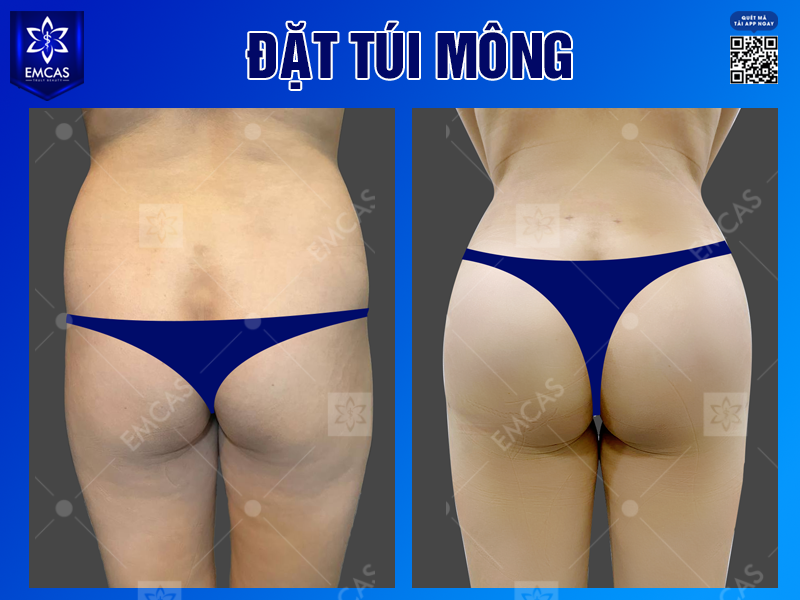 Một Số Phương Pháp Nâng Mông Phổ Biến Hiện Nay