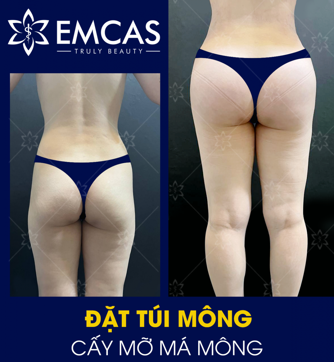Đặt Túi Mông - Giải Pháp Nhanh Chóng Để Sở Hữu Vòng 3 Đầy Đặn