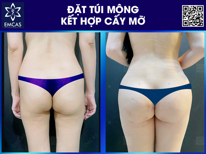 Một Số Phương Pháp Nâng Mông Phổ Biến Hiện Nay