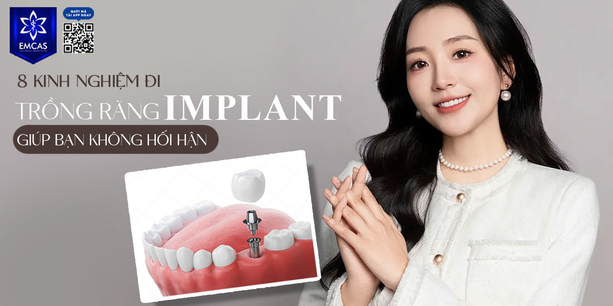 8 KINH NGHIỆM ĐI TRỒNG RĂNG IMPLANT GIÚP BẠN KHÔNG HỐI HẬN