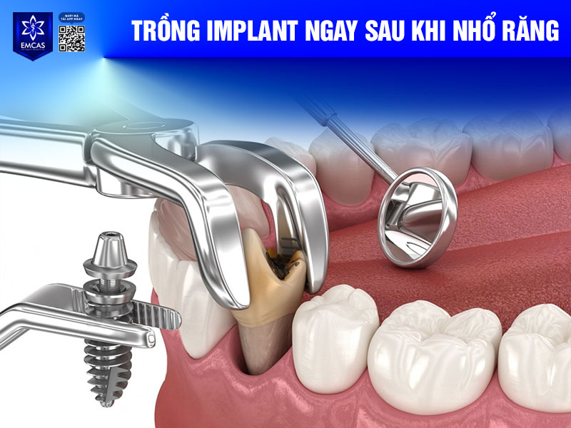  Cấy Implant ngay sau khi nhổ răng là kỹ thuật hiện đại, giúp hạn chế tiêu xương và rút ngắn thời gian điều trị