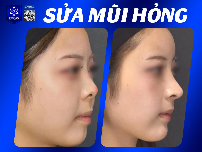 Với người bị bao xơ mũi nặng, mô xơ quá dày hoặc mũi lệch, bác sĩ có thể phải can thiệp bóc tách mô xơ, tái định hình sụn hoặc thay chất liệu mới.