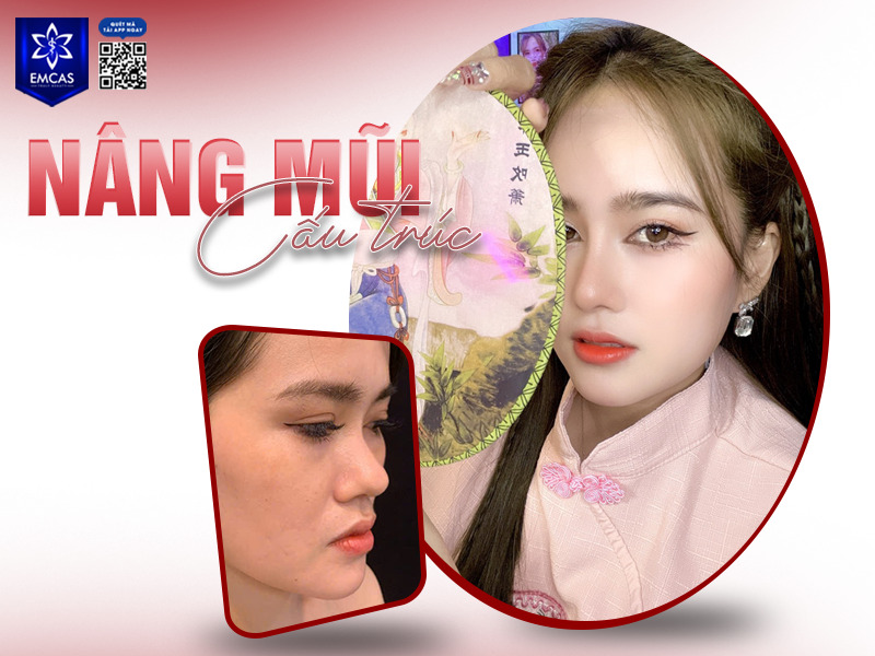 Nâng mũi cấu trúc là phương pháp thẩm mỹ có sự can thiệp và chỉnh sửa cấu trúc mũi nhằm cải thiện dáng mũi