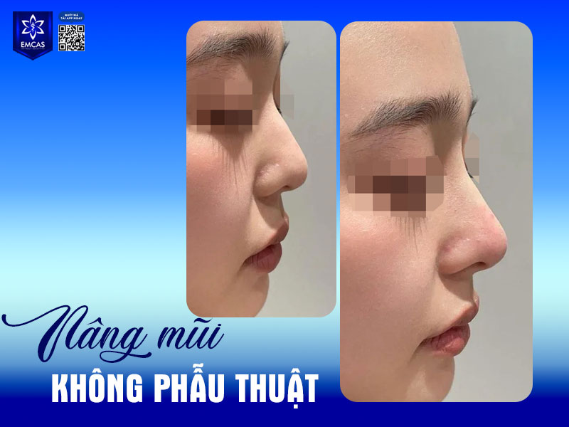 Nâng mũi không phẫu thuật chỉ phù hợp với người có ít khuyết điểm ở vùng mũi