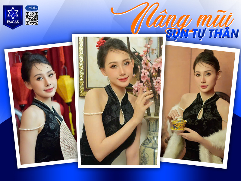 Nâng mũi sụn tự thân sử dụng sụn sườn, vách ngăn mũi, sụn tai hoặc kết hợp các loại sụn