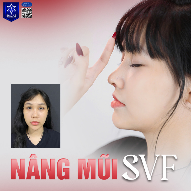 Nâng mũi SVF sử dụng sụn nâng mũi kết hợp cùng công nghệ SVF giàu tế bào gốc được chiết tách từ mỡ tự thâ