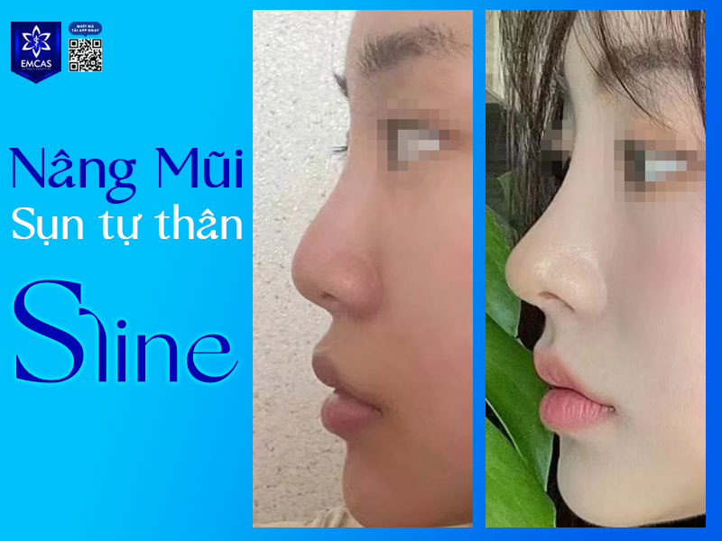 Dù các cách làm mũi cao ở tuổi dậy thì trên tương đối an toàn, nhưng nếu thực hiện sai cách hoặc lạm dụng, chúng vẫn có thể gây tổn thương vùng mũi hoặc phản tác dụng.