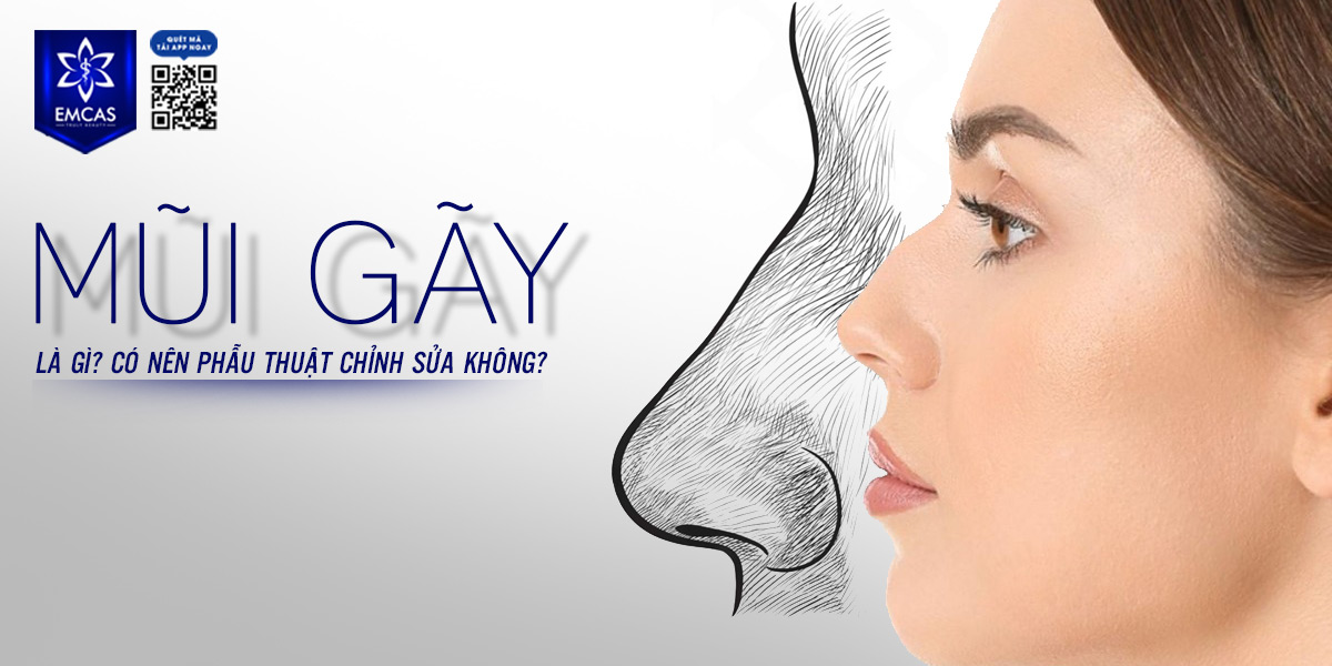 MŨI GÃY LÀ GÌ? CÓ NÊN PHẪU THUẬT CHỈNH SỬA KHÔNG?