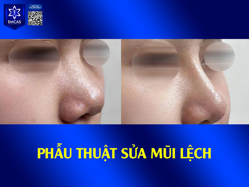 Có nhiều phương pháp nắn lại sống mũi bị lệch phù hợp với mức độ và nguyên nhân gây ra tình trạng này, từ những cách đơn giản đến việc can thiệp bằng phẫu thuật.