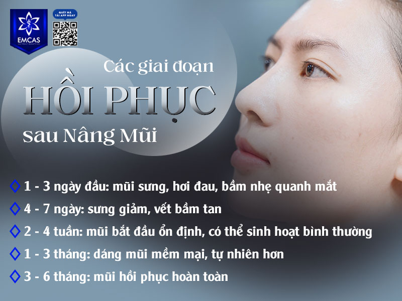 Sau khi thực hiện nâng mũi, cơ thể sẽ trải qua nhiều giai đoạn hồi phục khác nhau trước khi dáng mũi ổn định hoàn toàn.