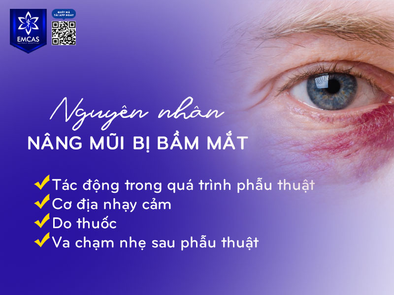 Tình trạng nâng mũi bị bầm mắt thường xuất hiện trong vài ngày đầu sau phẫu thuật, do sự tác động của quá trình bóc tách mô, va chạm mạch máu