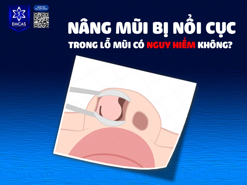 Nâng mũi bị nổi cục trong lỗ mũi là một tình trạng tạm thời, không gây nguy hiểm cho sức khỏe và sẽ hết sau vài tháng