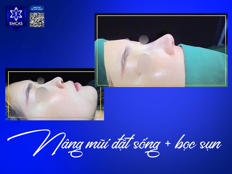 Nâng mũi bọc sụn là kỹ thuật thẩm mỹ mũi kết hợp giữa sụn nhân tạo để nâng cao sống mũi và sụn tự thân (thường lấy từ vành tai) để bọc phần đầu mũi.