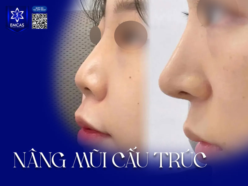 Nâng mũi cấu trúc là phương pháp can thiệp chỉnh sửa toàn diện dáng mũi từ sống, đầu mũi đến trụ mũi, khắc phục triệt để các khuyết điểm, tái cấu trúc lại toàn bộ