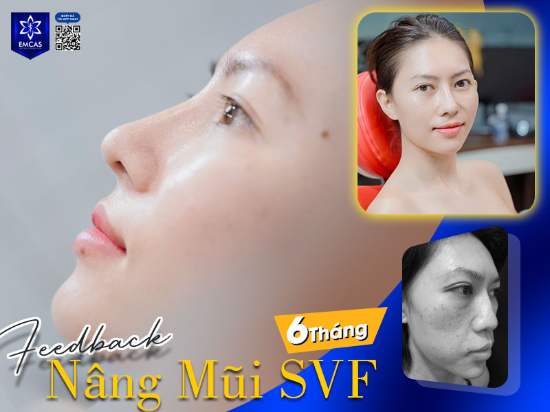 Nếu bạn đang tìm kiếm một địa chỉ nâng mũi cấu trúc uy tín và đáng tin cậy, Bệnh viện Thẩm mỹ EMCAS là một lựa chọn hàng đầu tại TP.HCM