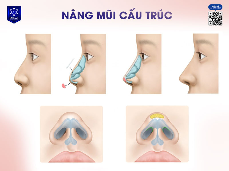 Nâng mũi cấu trúc là dịch vụ thẩm mỹ được ưa chuộng hiện nay mang lại dáng mũi tự nhiên, cân đối bằng cách tái cấu trúc phần trụ, sống và đầu mũi.