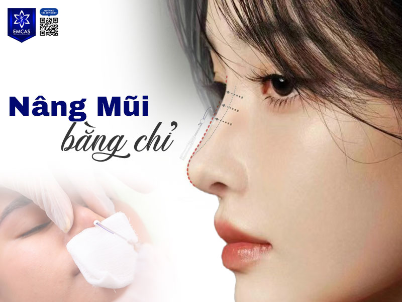 Sau khi nâng mũi bằng chỉ khoảng 2-4 tuần, dáng mũi sẽ dần ổn định
