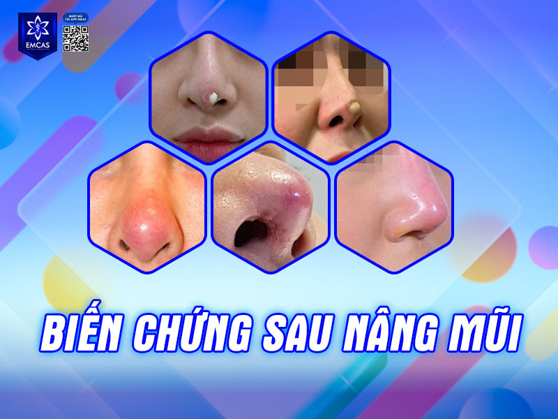 Các biến chứng sau nâng mũi mà bạn cần lưu ý