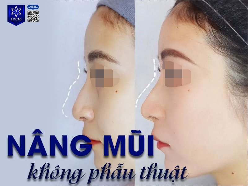 Nâng mũi không cần phẫu thuật dành cho người muốn cải thiện dáng mũi mà không muốn can thiệp dao kéo, xâm lấn
