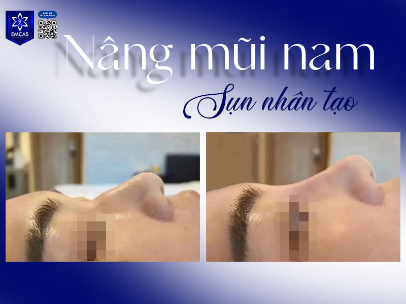 Một ca nâng mũi nam đẹp không chỉ giúp gương mặt hài hòa mà còn giữ được vẻ nam tính đặc trưng