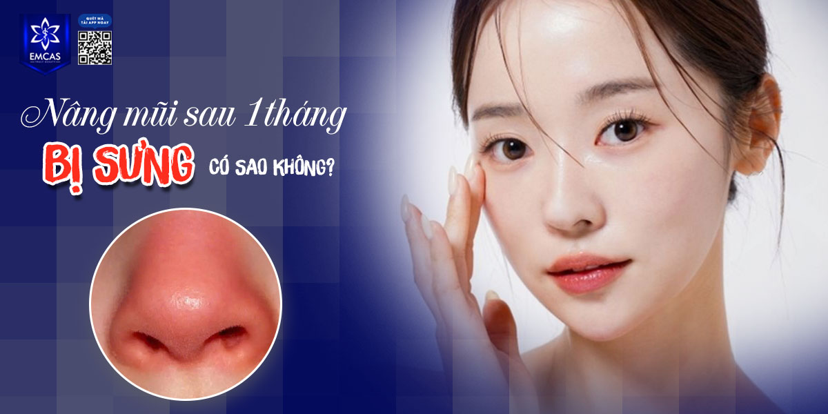 NÂNG MŨI SAU 1 THÁNG BỊ SƯNG CÓ SAO KHÔNG? [GIẢI ĐÁP THẮC MẮC]