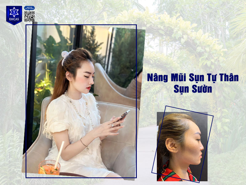 Sụn sườn khi đặt vào sẽ được nuôi dưỡng bởi hệ thống máu và mô ở mũi do đó không có tình trạng bị teo lại theo thời gian.