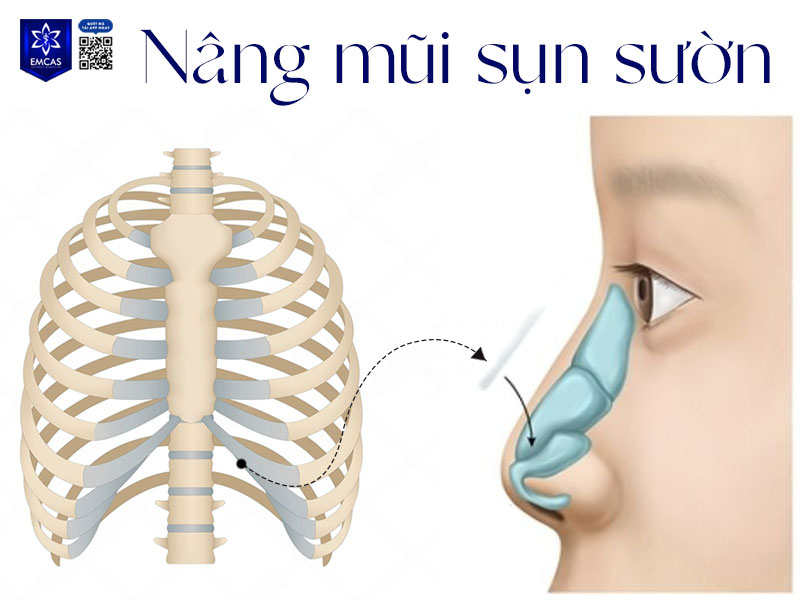 Nâng mũi sụn sườn là một phương pháp phẫu thuật thẩm mỹ lấy sụn sườn nâng mũi, cải thiện hình dáng và cấu trúc của mũi.