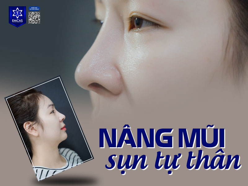 Bệnh Viện Thẩm Mỹ EMCAS địa chỉ nâng mũi uy tín