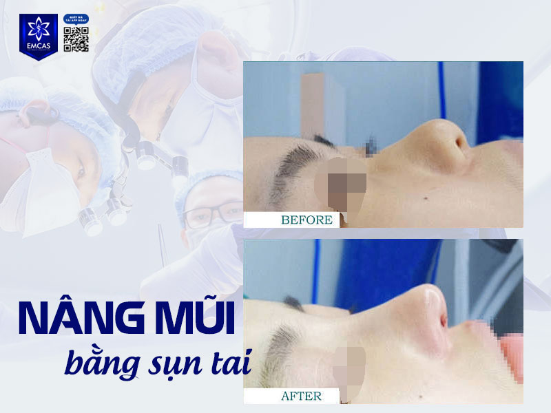 chi phí nâng mũi sụn tai dao động từ 25 triệu