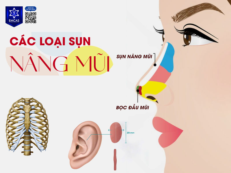 Sụn tự thân thường được lấy từ sụn sườn, tai, vách ngăn mũi