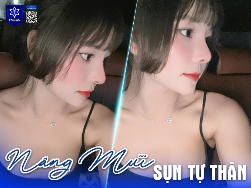 Việc lựa chọn loại sụn nâng mũi còn phụ thuộc vào nhu cầu của bạn và đánh giá của bác sĩ chuyên khoa