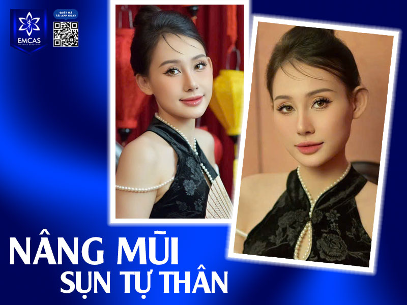 Nâng mũi sụn tự thân sử dụng vật liệu từ chính cơ thể bạn như sụn sườn, tai để cải thiện dáng mũi.
