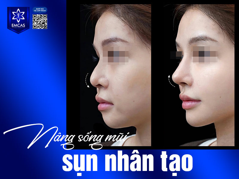 Chăm sóc hậu phẫu đúng cách đóng vai trò quan trọng, giúp mũi nhanh hồi phục, hạn chế biến chứng và duy trì kết quả thẩm mỹ lâu dài.