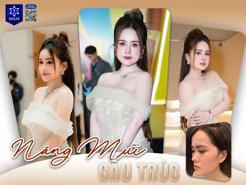 Việc xác định đúng thời điểm và đối tượng chỉ định sẽ giúp đảm bảo an toàn cũng như duy trì kết quả nâng mũi lâu dài.