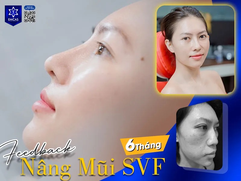 Sửa mũi hỏng tại EMCAS