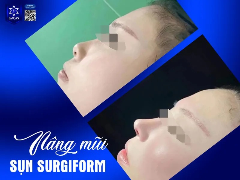 Nâng mũi sụn nhân tạo là một trong những sự lựa chọn phổ biến nhất hiện nay với nhiều ưu điểm như quy trình thực hiện nhanh, hiệu quả, chi phí hợp lý và phù hợp với nhiều đối tượng.