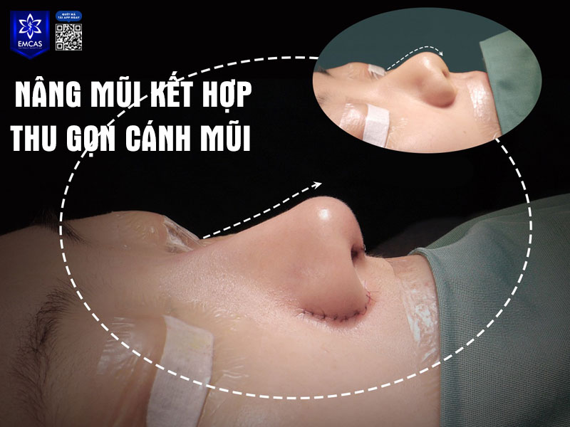 Phẫu thuật thu gọn cánh mũi là một thủ thuật nhằm điều chỉnh phần chân cánh mũi to, bè hoặc thô, giúp tổng thể mũi trông gọn gàng, thanh thoát và hài hòa hơn với khuôn mặt