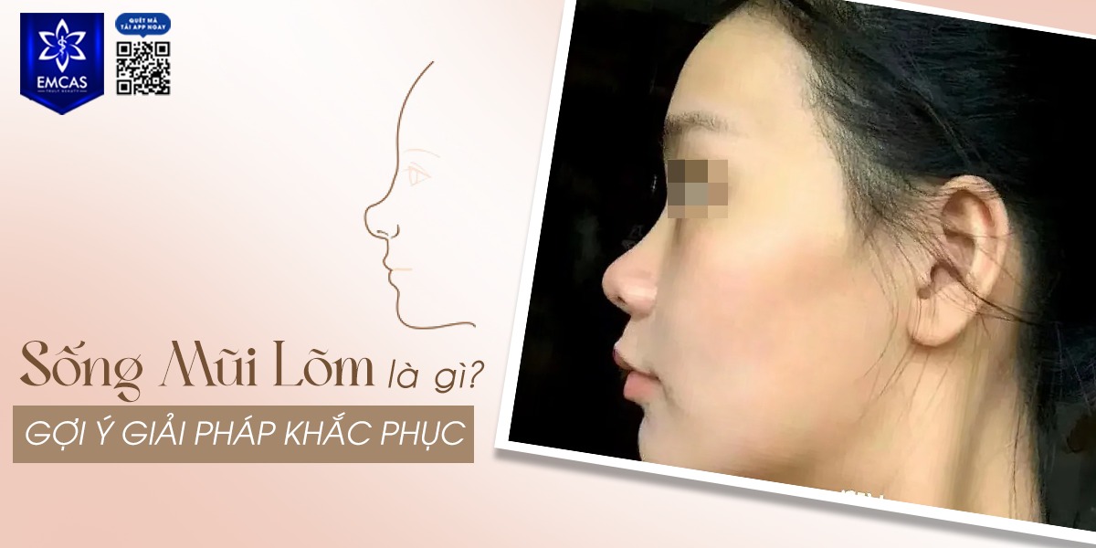 SỐNG MŨI LÕM LÀ GÌ? GỢI Ý GIẢI PHÁP KHẮC PHỤC