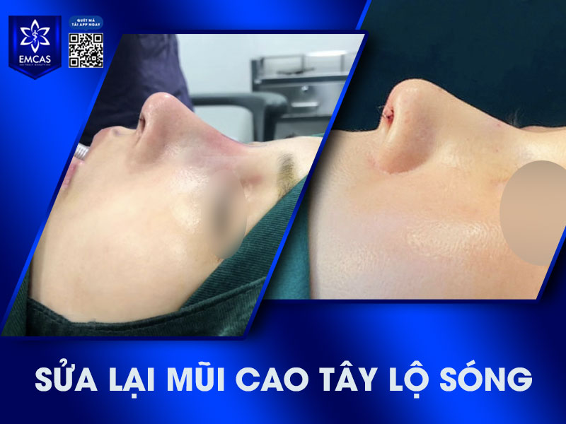 Tại Bệnh Viện Thẩm Mỹ EMCAS, quy trình sửa mũi cao tây lộ sóng tập trung vào hai mục tiêu chính: khắc phục triệt để tình trạng lộ sóng và tái tạo dáng mũi hài hòa, phù hợp với cấu trúc gương mặt.